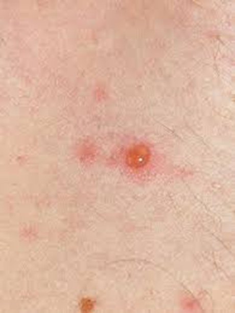 艾滋病初期 皮肤红点 症状图片