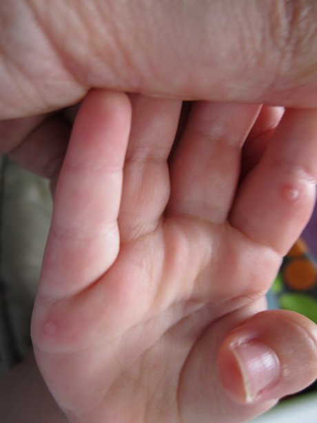 手足口病初期症状小孩手心是什么样图片