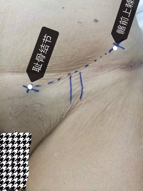 张学民:如何进行股动脉穿刺_北京大学人民医院_|张学民|_365心血管网