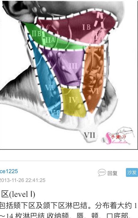 颈部淋巴结分区示意图-淋巴瘤之家