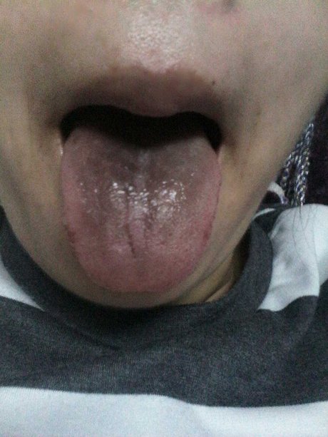 舌苔发黑怎么了?