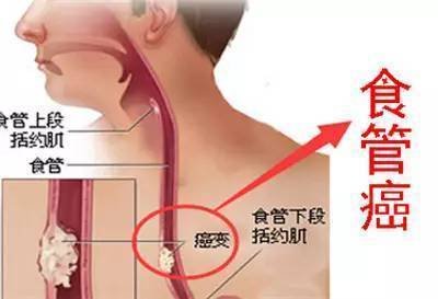 食管癌
