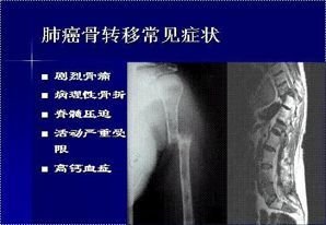 骨转移