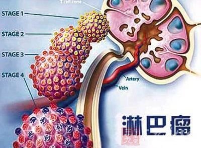 淋巴瘤