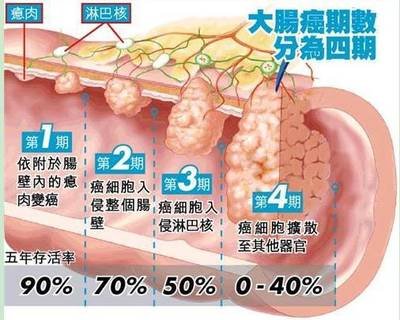 肠癌