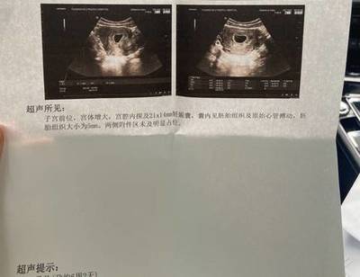 刚怀孕一周会恶心吗
