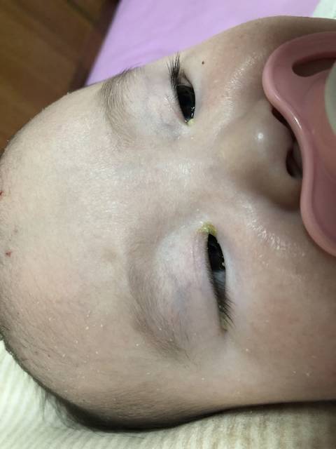 七个月宝宝眼屎多图片