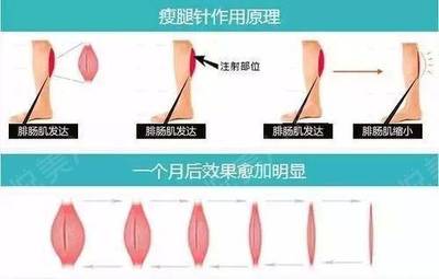 吸脂瘦腿效果如何