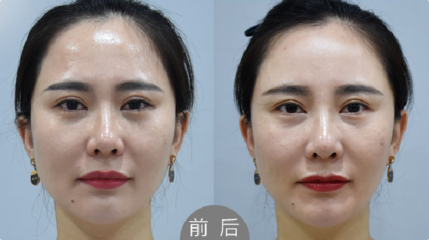 玻尿酸鼻唇沟多少钱