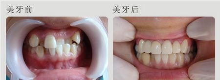 牙齿修正大概多少钱一个