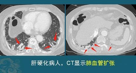 肝硬化血管修复手术多少钱