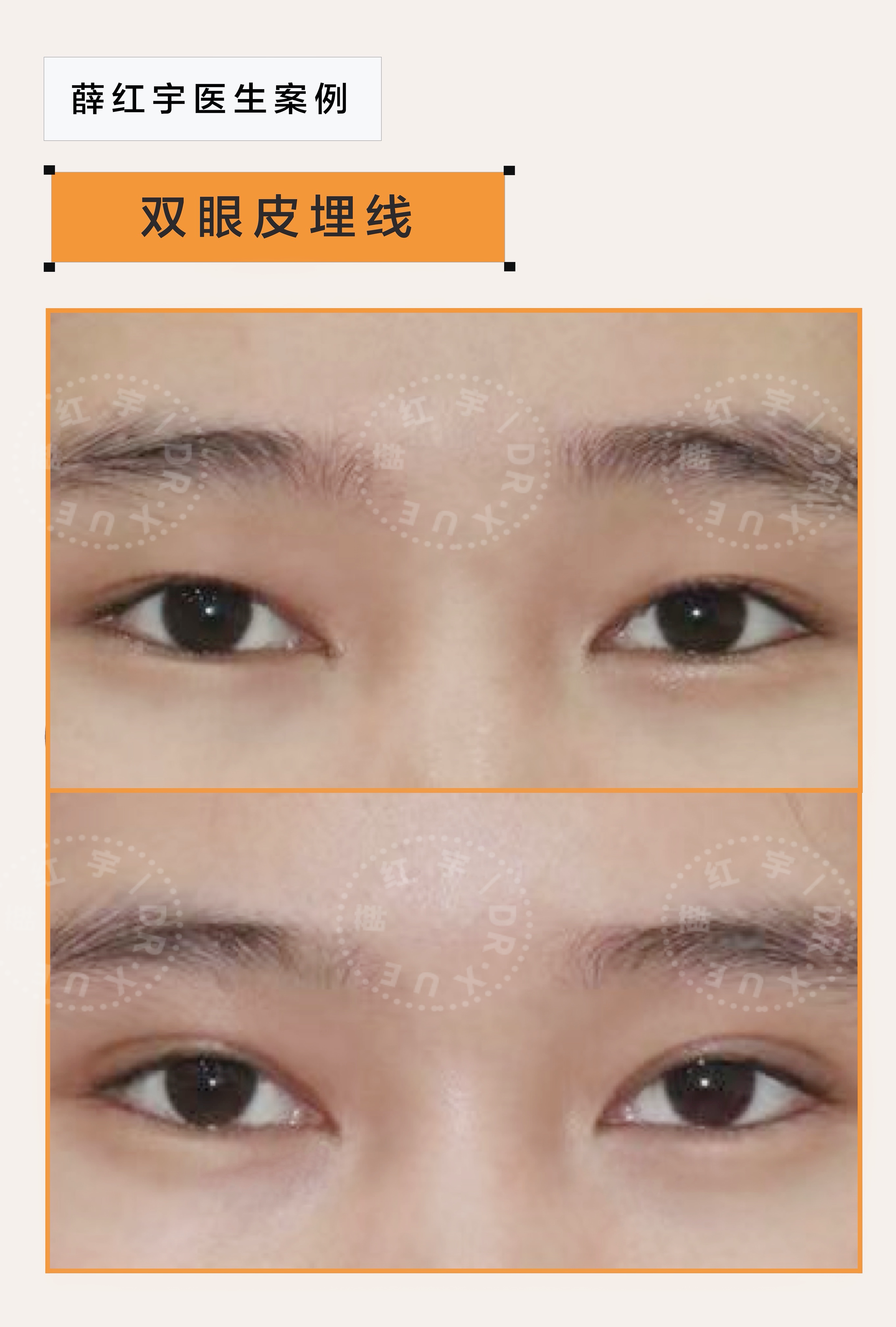 薛红宇双眼皮案例