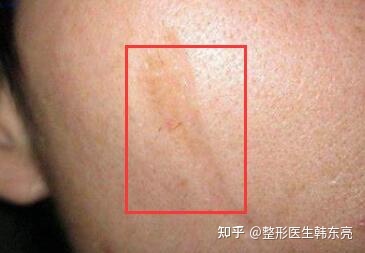 红色痘痘疤痕怎么消除