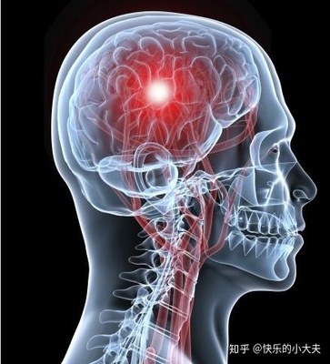 腔隙灶怎么治疗