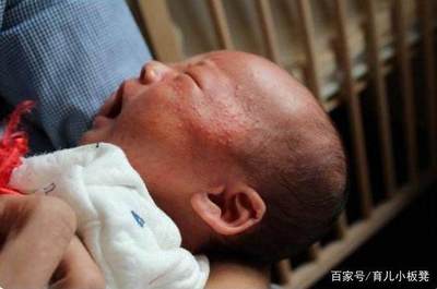 宝宝荨麻疹可以洗澡吗