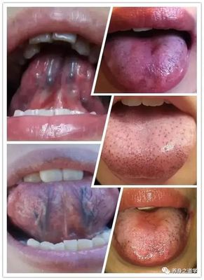 嘴唇边上长黑色痘痘