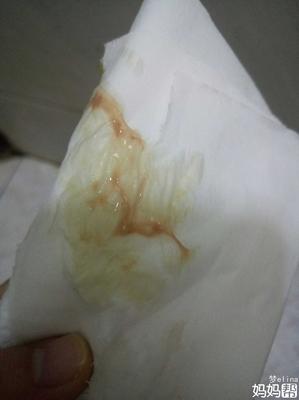白带有点咖啡色是怎么回事