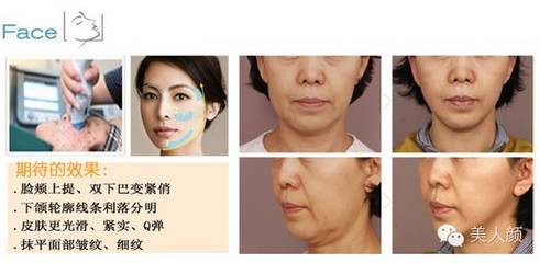 脸部提拉怎么做