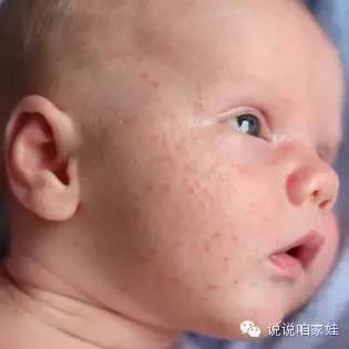 如何让脸上痘痘不复发