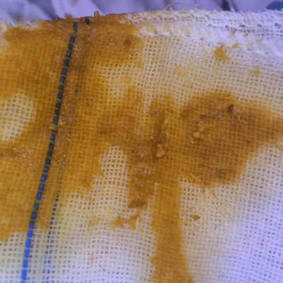 宝宝大便有块状物图片