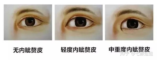 好看的内眦双眼皮