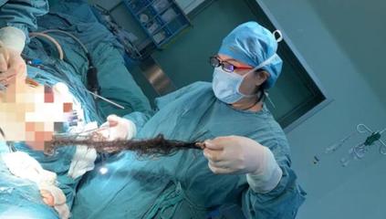 新生儿腹腔囊肿