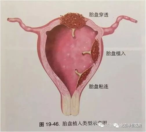 盆腔粘连能怀孕吗