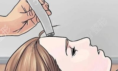 电烧伤疤痕