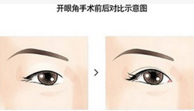 八大处整形美容眼睛