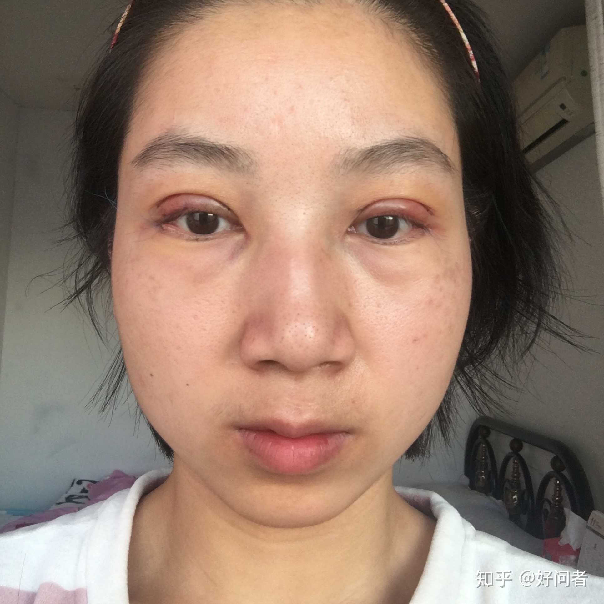 眼角有血丝是怎么回事