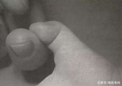 宝宝大拇指伸不直图片