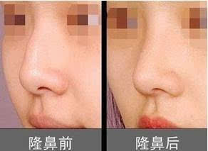 注射隆鼻效果好么
