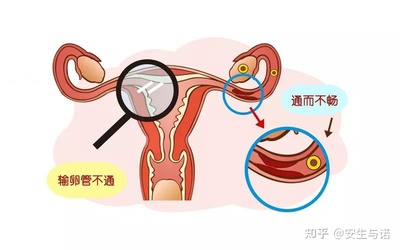 输卵管不通是怎么回事
