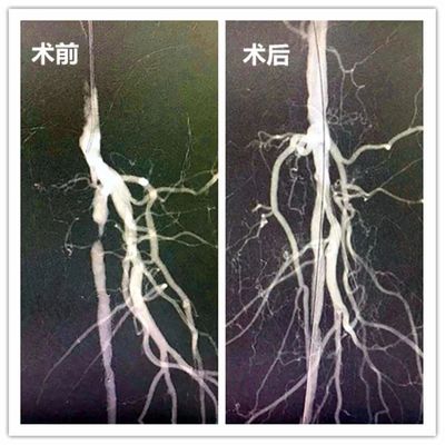 下肢动脉硬化旋切手术多少钱