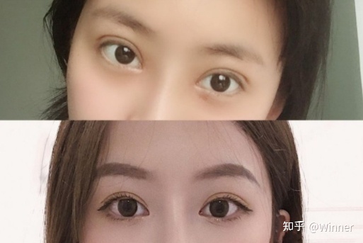双眼皮如何修复