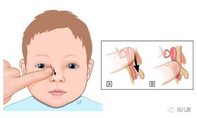 新生儿泪道堵塞的症状