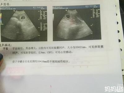 吃孕酮对胎儿有影响吗