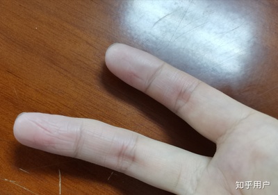 手指上起皮是怎么回事
