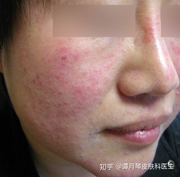 玫瑰痤疮怎么治疗最快