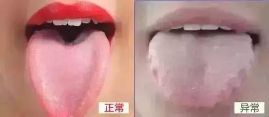 舌头有点肿是怎么回事