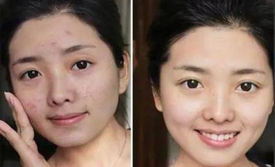 运动与痘痘
