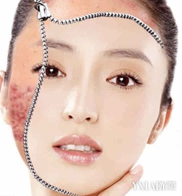 脸上后背长痘痘怎么办