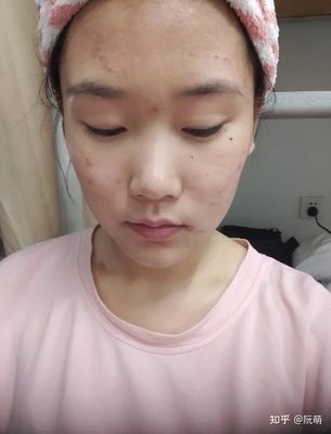 脸上有痘痘不挤会怎样