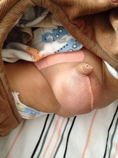 新生儿疝气