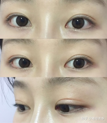 双眼皮成功案例