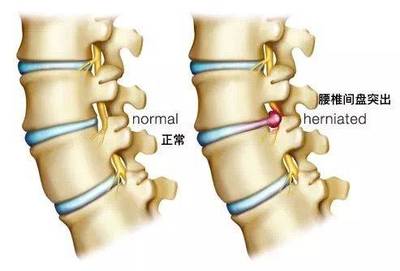腰间狭窄是怎么回事