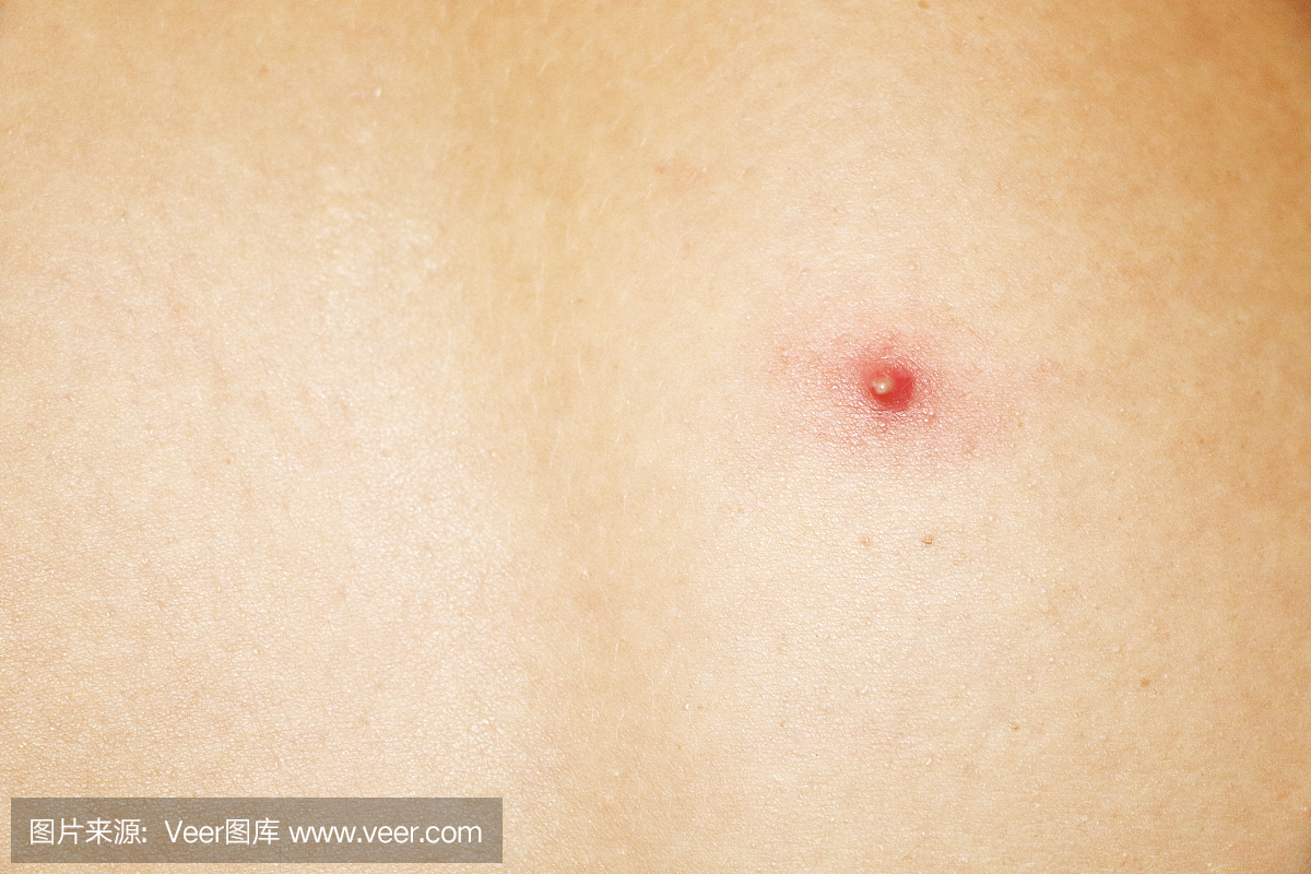 后背毛孔密密麻麻黑点