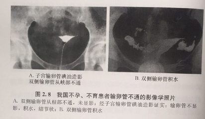 治疗盆腔结核费用多少