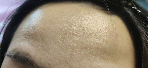额头眉毛上长痘痘是什么原因