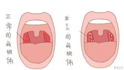 老是胃热是怎么回事